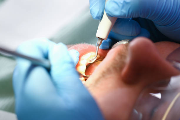 Best Emergency Wisdom Tooth Extraction in East Freehold, NJ