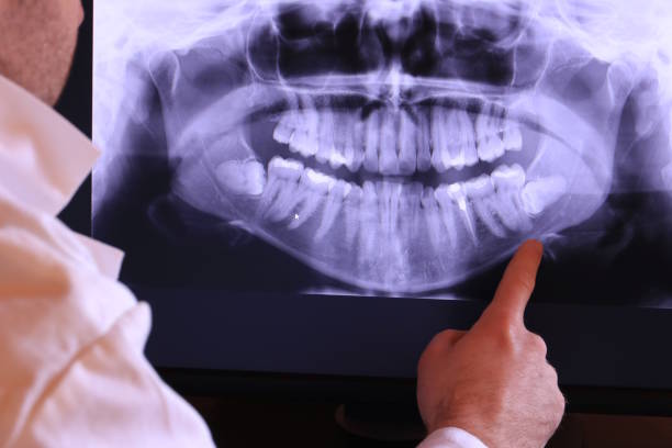 Best Emergency Wisdom Tooth Extraction in East Freehold, NJ