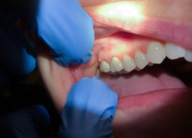 Best Lost Filling or Crown Replacement in East Freehold, NJ